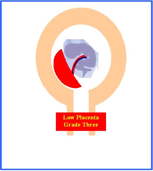 Placenta Praevia Grade Three Dr Youssif